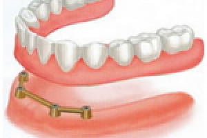Съемные зубные протезы на имплантах