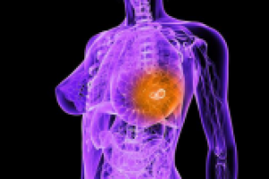 Лечение рака молочной железы в Израиле