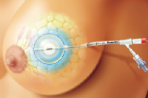 Восстановление груди в клинике Ассута в Израиле