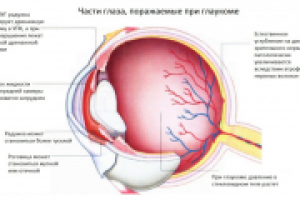 Лечение глаукомы в Израиле