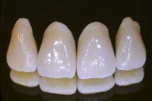 Мосты и коронки из металлокерамики