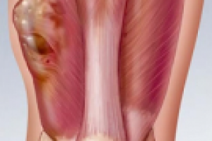 Лечение саркомы мягких тканей в Израиле