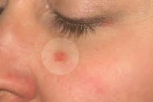 Диагностика и лечение базалиомы в Израиле