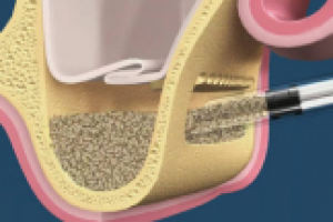 Наращивание костной ткани для последующей имплантации