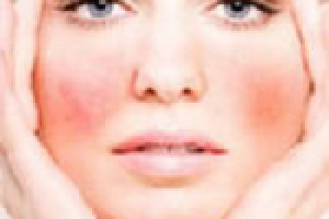 Лечение купероза лазером (отзыв)