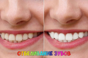 Отбеливание зубов