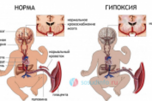 Гипоксия у плода и новорожденного — причины, симптомы, лечение
