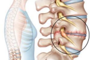 Грыжа Шморля