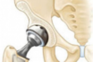 Эндопротезирование тазобедренного сустава