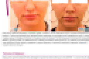 Текст услуги "Удаление комков Биша" для клиники "Эл.Эн."