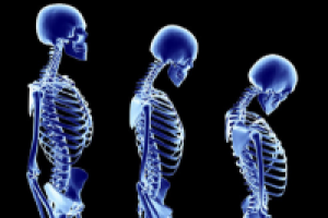 Брошюра для препарата против остеопороза