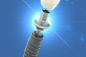 Визуализация импланта на сайт