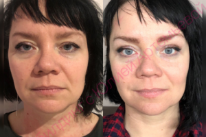 Результат за 5 недель.Эффект блефаропластики