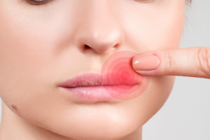 Герпес на губах — признак слабого иммунитета