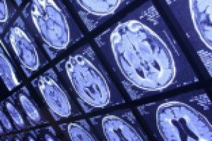 Причины ухудшения мышления при депрессии, СДВ и ПМС