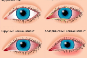Чем опасен детский конъюнктивит?
