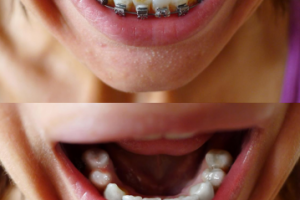 Удаление брекетов