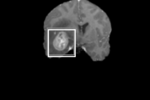 Определение опухоли мозга по снимкам МРТ