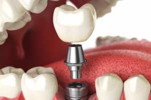 Восстановление зубов с помощью имплантации