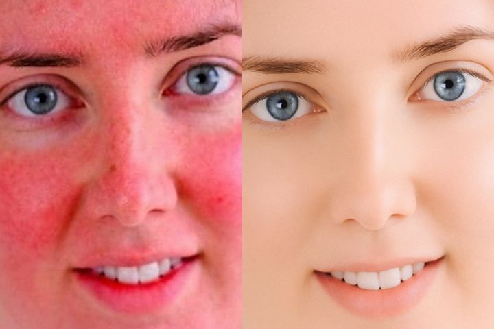 Уберу красноту, покраснения, красные капиляры, пятна, красные глаза - 5589498