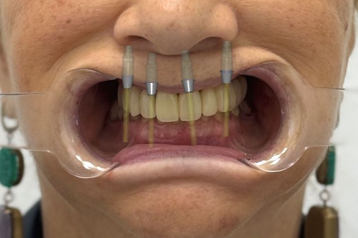 3 д моделирование в  экзокад,exocad, CAD design - 5688645