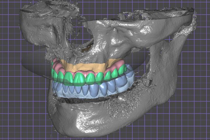 3 д моделирование в  экзокад,exocad, CAD design - 5688650