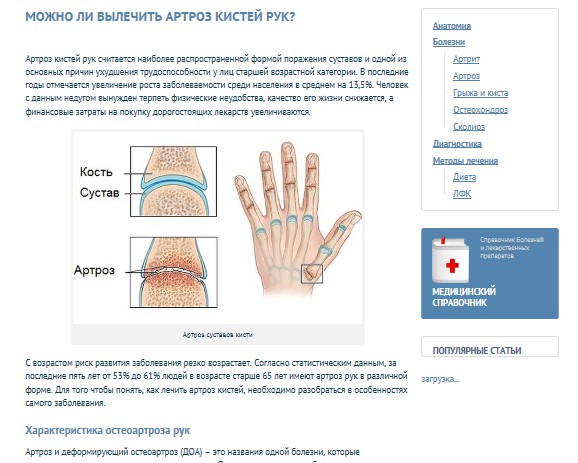 Схема лечения артрита кистей рук